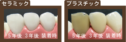 セラミック歯とプラスチック歯