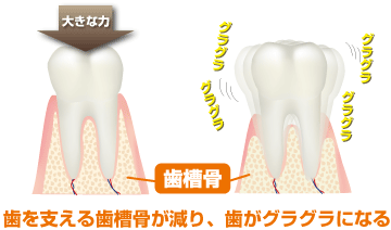 歯を支える歯槽骨が減り、歯がグラグラになる